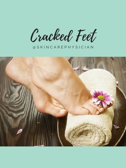 Cracked feet are a common issue, especially in winter. This guide will help you understand how to manage them effectively at home.