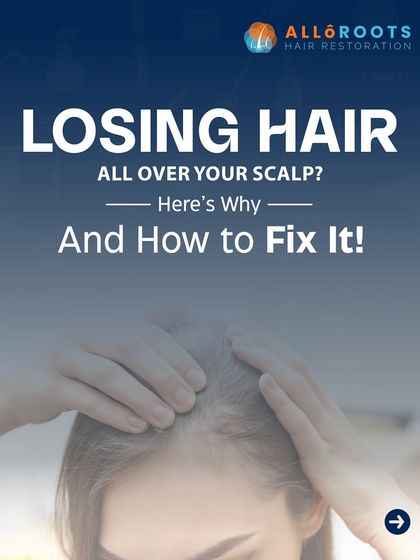 Are you losing hair all over your scalp? This condition, known as diffuse hair loss or Telogen Effluvium, is often caused by triggers like stress, nutritional gaps, or poor scalp hygiene. The good news is that it is often reversible once the root cause is addressed.