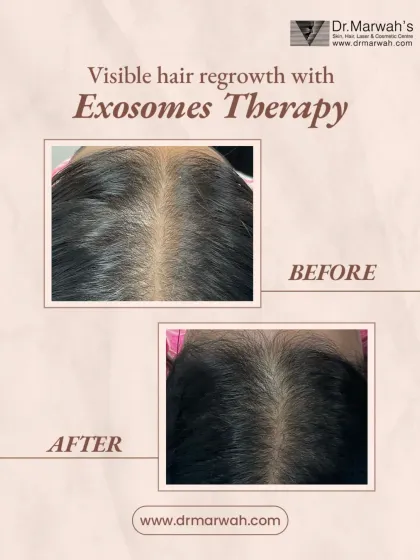 This is a clear example of visible hair regrowth achieved with our non-surgical Exosomes Therapy. The after photo shows significantly improved hair density and scalp coverage, demonstrating how the treatment works from within to rejuvenate hair follicles.
