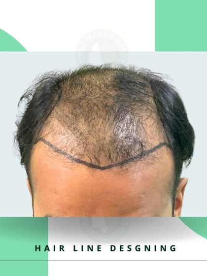 This image shows the hairline design for a client with significant frontal hair loss. The plan is to create a strong, dense hairline that will frame his face and restore a youthful look.
