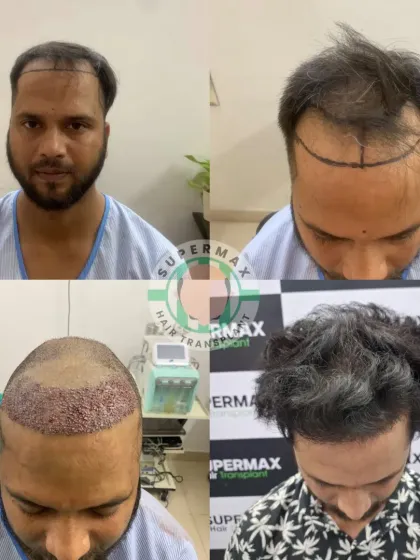 A fabulous 6-month result. This collage shows the journey from the initial markings and transplant to a full, stylish look.