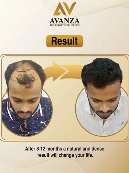 After 8-12 months, a natural and dense result can change your life. This image perfectly illustrates the journey from balding to a full head of hair.