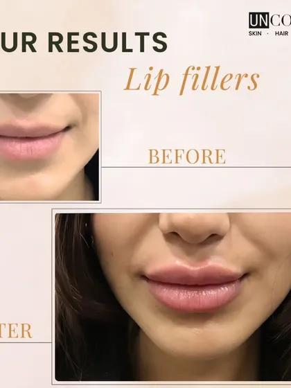 This is a great example of our approach to lip fillers. We focus on enhancing the natural shape and restoring volume for a soft, beautifully balanced result that complements your features.