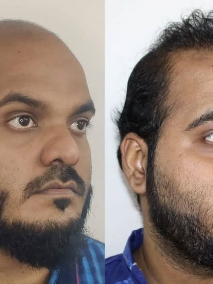 This angle further demonstrates the natural-looking density and the positive change in the patient's overall appearance.