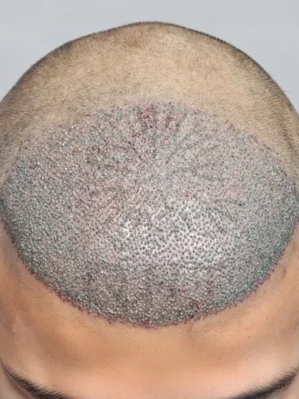 A high-density transformation in progress. 4000 grafts were implanted to rebuild the hairline and cover the mid-scalp.