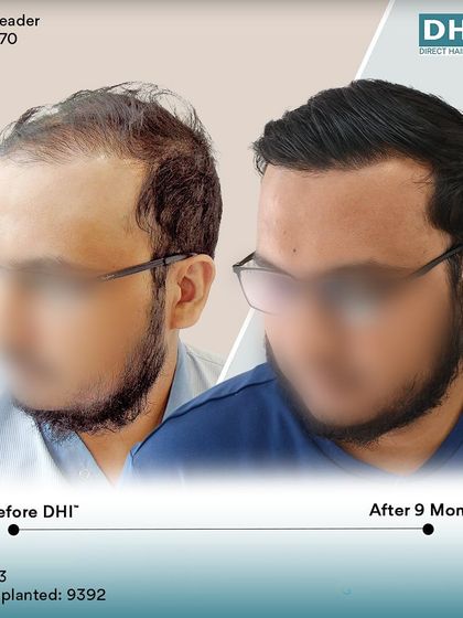 Another side-profile view of the 9-month result. This angle highlights the seamless flow and density from front to back, a testament to the meticulous work of our doctor-led team.