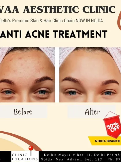A compelling before-and-after result from our targeted anti-acne treatment. This image effectively shows the reduction in inflammation and blemishes, representing our expertise in creating clear, healthy skin.