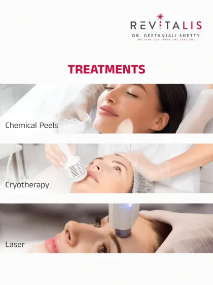 Professional Treatments for Milia Removal. Since milia cannot be popped, professional removal is necessary. I offer safe and effective treatments like chemical peels, cryotherapy, and laser to remove them.