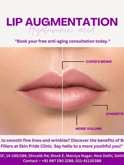 This before and after graphic illustrates the power of lip augmentation with hyaluronic acid fillers. See how we create more volume, improve symmetry, and define the cupid's bow for a youthful and balanced look.