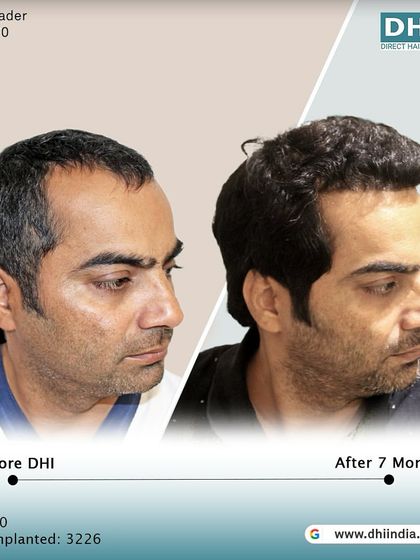 A side-profile view of a 40-year-old client 7 months after his procedure. With 3,226 hairs implanted, his hairline is restored and his hair looks significantly fuller and healthier.
