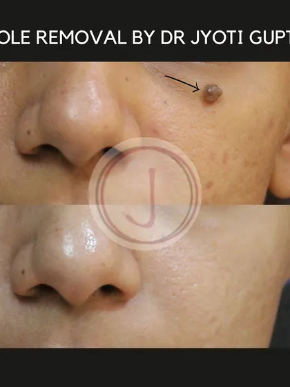This before and after image shows a mole removal procedure using Radio Frequency Ablation. This technique allows for the precise and safe removal of benign moles with minimal scarring, providing a clean aesthetic result.