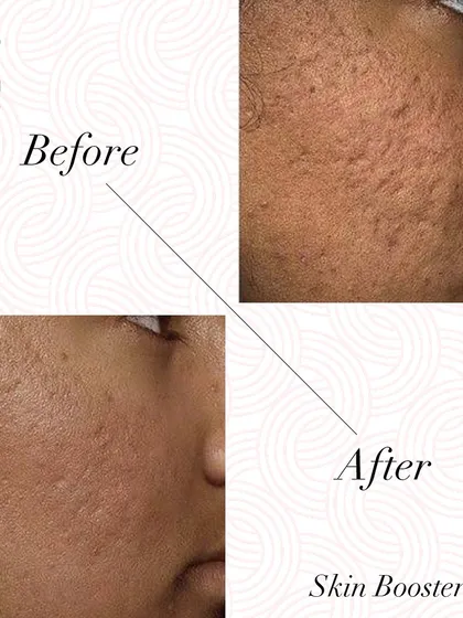 Skin boosters are not just for a glow, they can also significantly improve skin texture. This client saw a noticeable reduction in the appearance of acne scars after their treatment, resulting in smoother skin.