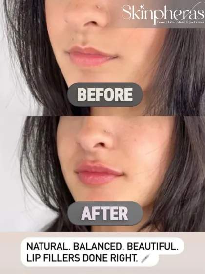 A clear demonstration of a natural lip filler enhancement. The 'after' image shows beautifully balanced, hydrated, and defined lips that complement the client's facial features without looking overdone.