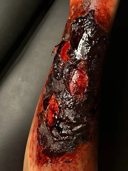 This is an example of my hyper-realistic injury effects, created for film and TV shoots. I used professional-grade silicone and specialized coloring techniques to create the texture and depth of a severe burn, making it look completely real on camera.