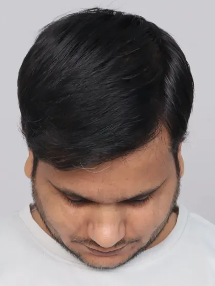 This Norwood Grade 4A patient's 14-month transformation after a single session with 4000 grafts. We restored his hairline and frontal region for a fuller, more confident look.
