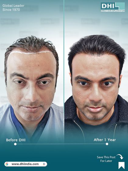 A one-year transformation showing a restored hairline and impressive density. This before and after comparison highlights the natural and permanent results achieved with our advanced DHI technique.