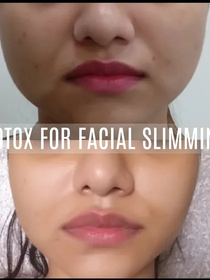 A strong, square jawline can sometimes create a sense of heaviness in the lower face. Using Botox in the masseter muscle is a non-surgical technique I use to soften the jawline, creating a slimmer, more balanced facial profile.