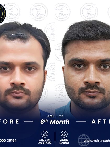A frontal view of the 6-month BIG FUE result, showcasing a natural and fuller hairline that has transformed his look.